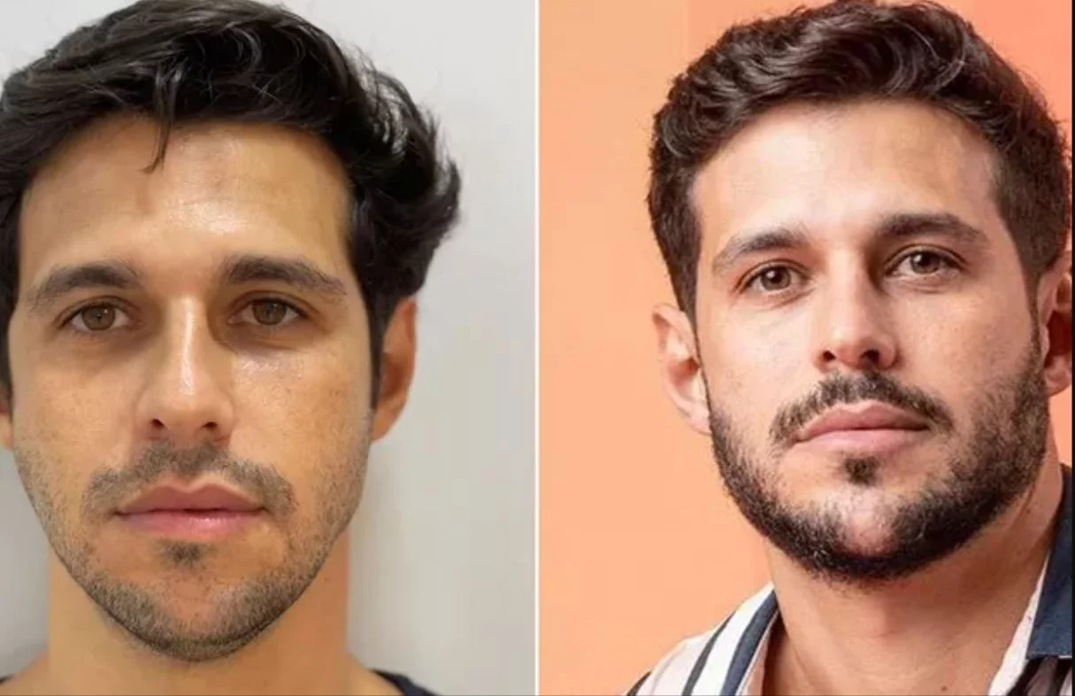 O ex-BBB Rodrigo Mussi passou pelo procedimento antes de entrar para o Big Brother. Ele fez preenchimentos com ácido hialurônico, principalmente para ganhar projeção do queixo.