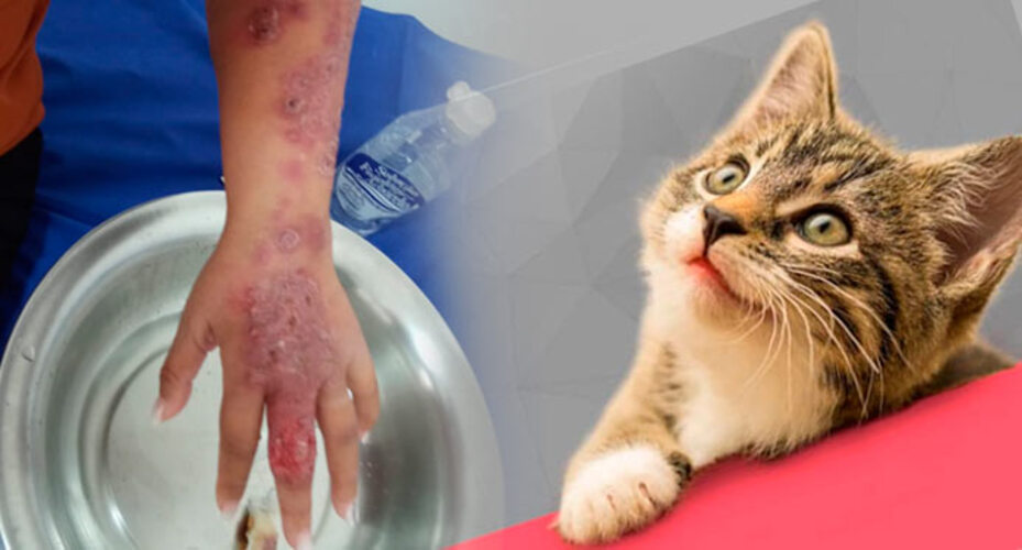 A esporotricose é uma infecção subcutânea (sob a pele) provocada por fungos do gênero Sporothrix. Esses micro-organismos, que vivem no solo, na vegetação em decomposição e em cascas de árvores, podem infectar humanos por arranhões, mordidas e secreções de gatos contaminados, resultando em uma infecção subcutânea com uma ou múltiplas lesões, principalmente nas mãos e braços.