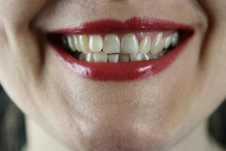 A escolha da melhor solução para cada caso dependerá de diversos fatores, como a quantidade de dentes perdidos, a saúde bucal do paciente e o orçamento disponível.