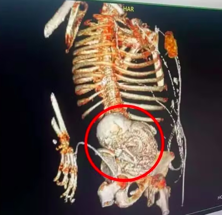 “Normalmente a mulher não apresenta sintomas, por isso essa condição acaba sendo diagnosticada por acaso somente anos depois da gravidez”, disse a obstetriz.