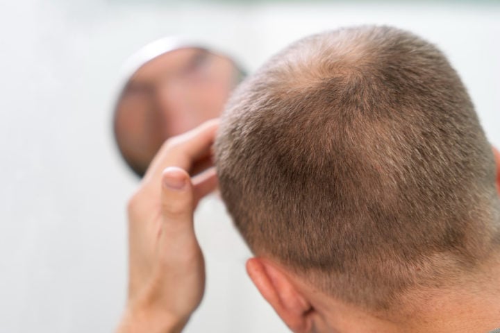 Embora não recuperem completamente o cabelo perdido, medicamentos como finasterida e minoxidil são eficazes para evitar a piora da queda, especialmente em homens.