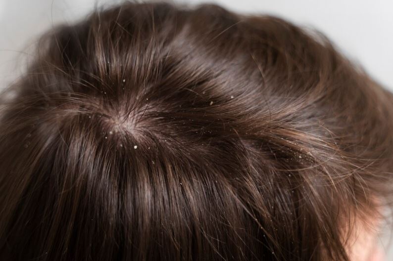 A caspa é um dos problemas de higiene e saúde que mais causam constrangimento nas pessoas. Muita gente se envergonha porque 
a caspa é visível e chama atenção na roupa.