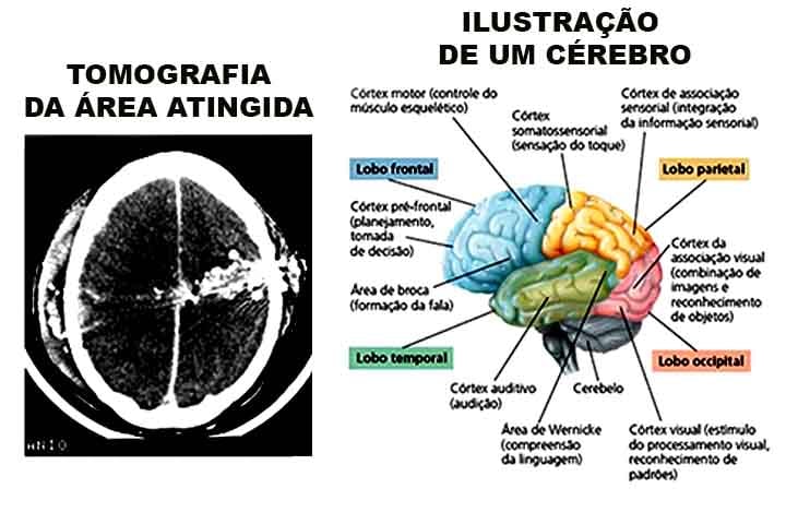 A cranioplastia não apenas devolve a normalidade visual, mas também garante a segurança e o bem-estar do paciente.
