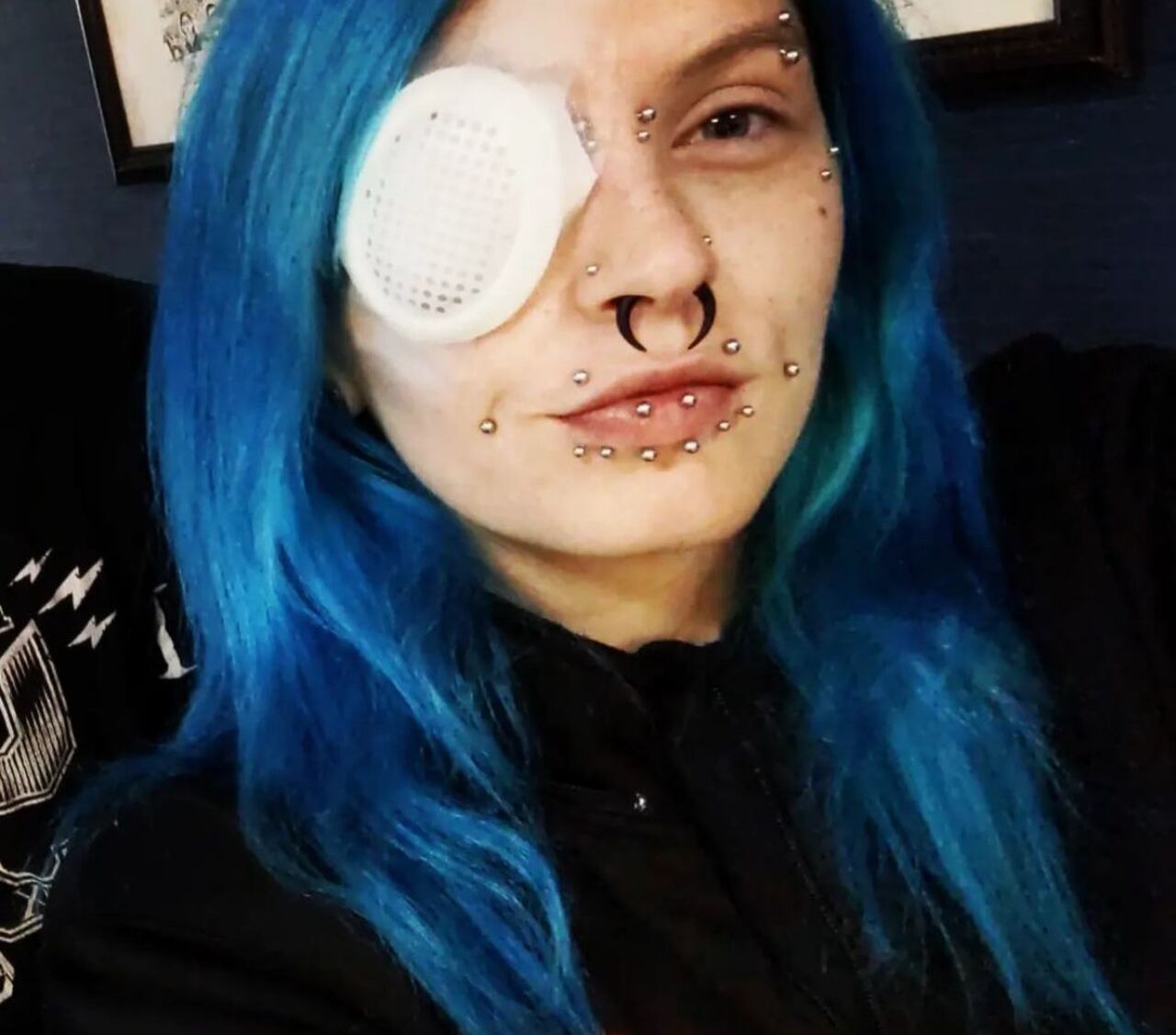 Entretanto, o tumor voltou mais agressivo cerca de um ano após o tratamento. Sendo assim, em 2022, ela precisou remover cirurgicamente o globo ocular.