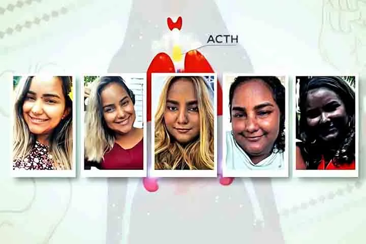 “Eu mudei de coloração muito rápido. Questão de meses, três, quatro meses”, contou Sabrina, referindo-se à pigmentação alterada de pacientes que têm superprodução de ACTH.