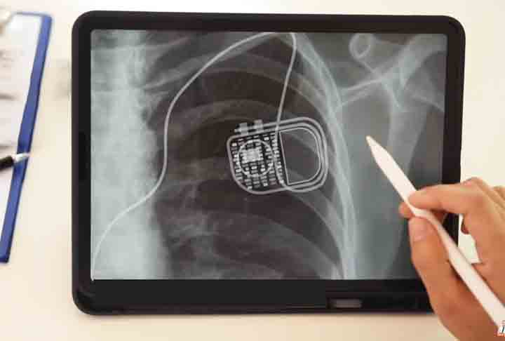 Por outro lado, nos casos de bradicardias (coração lento), os pequenos marca-passos, que emitem impulsos elétricos para corrigir falhas no ritmo dos batimentos, podem ser implantados.