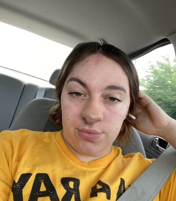 Após o incidente, a jovem tem enfrentado dificuldades emocionais. “[...]Agora também tenho um medo muito forte de cachorros. Estou tomando remédios e fazendo terapia para me ajudar a lidar com meu TEPT [transtorno do estresse pós-traumático].