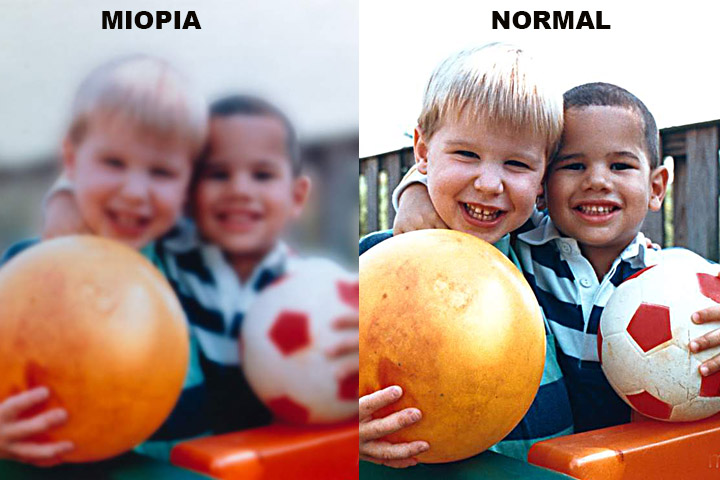 Atualmente, as lentes de contato são produzidas com materiais avançados, permitindo maior oxigenação dos olhos e adaptação personalizada para diferentes necessidades visuais. Elas são indicadas para diversas condições visuais, incluindo miopia, hipermetropia, astigmatismo e presbiopia.