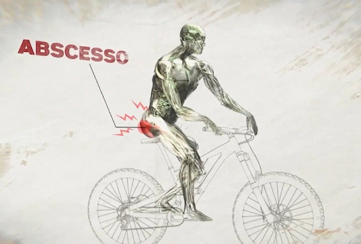 Um abscesso é uma inflamação causada por infecção, que forma uma bolsa de pus em alguma parte do corpo. Ele pode surgir na pele ou em órgãos internos. 