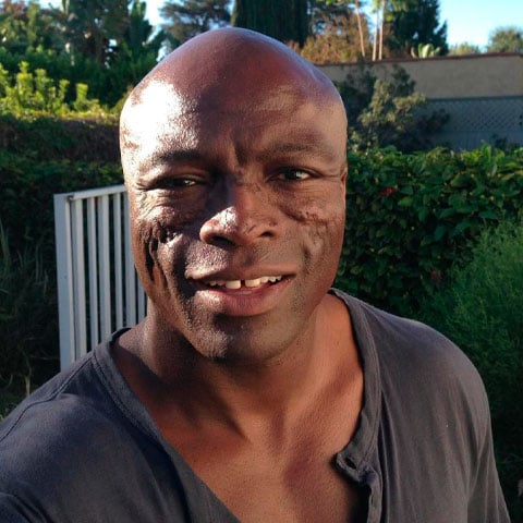 Seal, por exemplo, tem marcas visíveis no rosto causadas pela doença, além de ter perdido cabelo. Em uma entrevista de 2009, contou que recebeu o diagnóstico aos 21 anos.