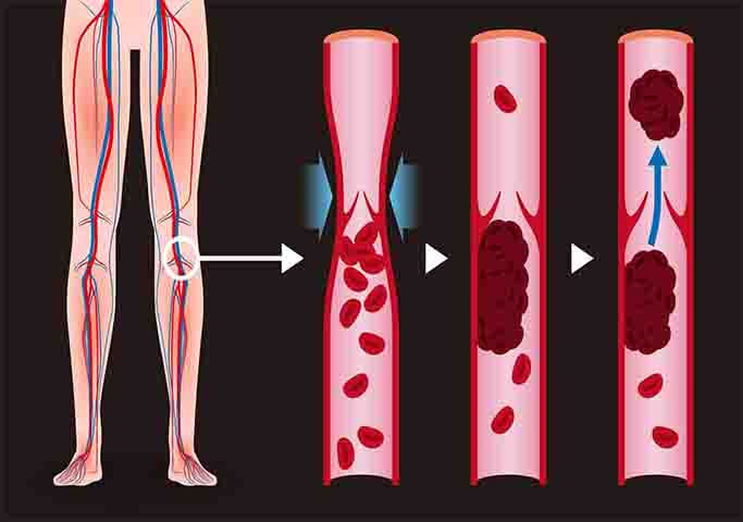 A trombose é uma formação de coágulos (massa semissólida de sangue) no interior de veias (trombose venosa) ou artérias (trombose arterial) impedindo o fluxo sanguíneo e podendo causar diversos sintomas ao corpo humano.