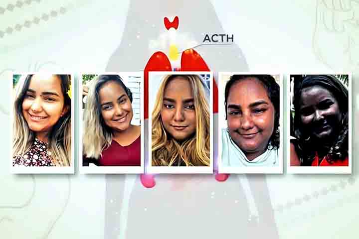 “Eu mudei de coloração muito rápido. Questão de meses, três, quatro meses”, contou Sabrina, referindo-se à pigmentação alterada de pacientes que têm superprodução de ACTH.