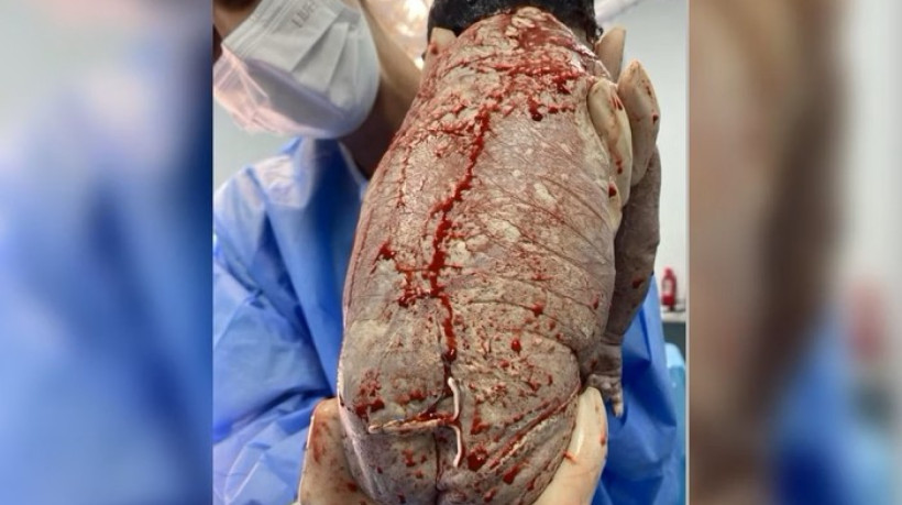 O bebê nasceu com 35 semanas e 5 dias de gestação e não precisou de UTI ou outras intervenções médicas
