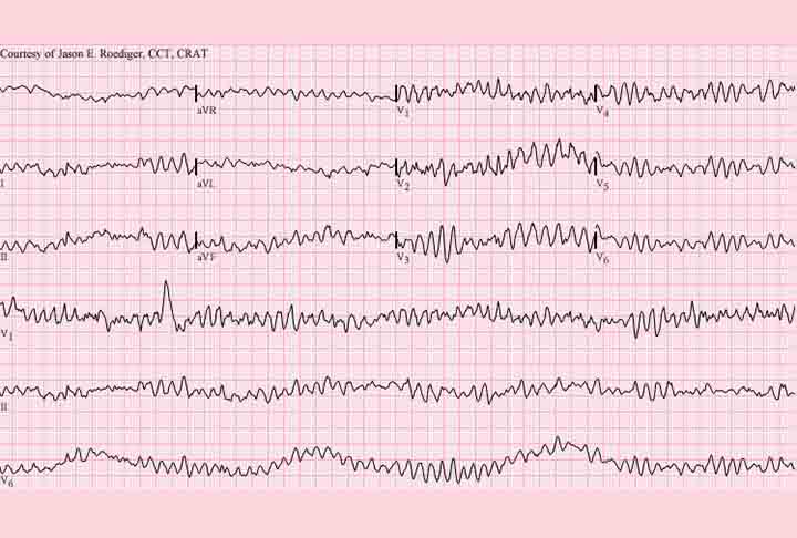 As alterações nesse funcionamento podem fazer o coração bater em ritmo muito acelerado (taquicardia) ou lento demais (bradicardia). A maioria das arritmias são benignas e não causam sintomas, porém algumas podem levar a situações preocupantes para a saúde.