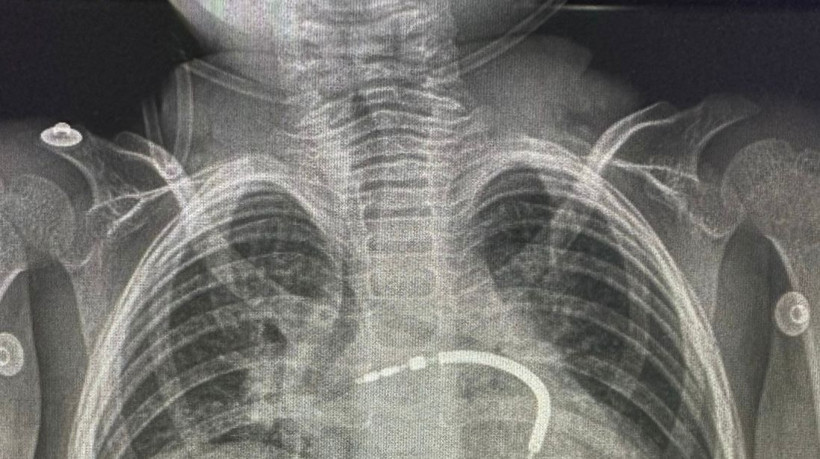 O dispositivo implantado evita episódios de morte súbita decorrentes da má-formação do coração