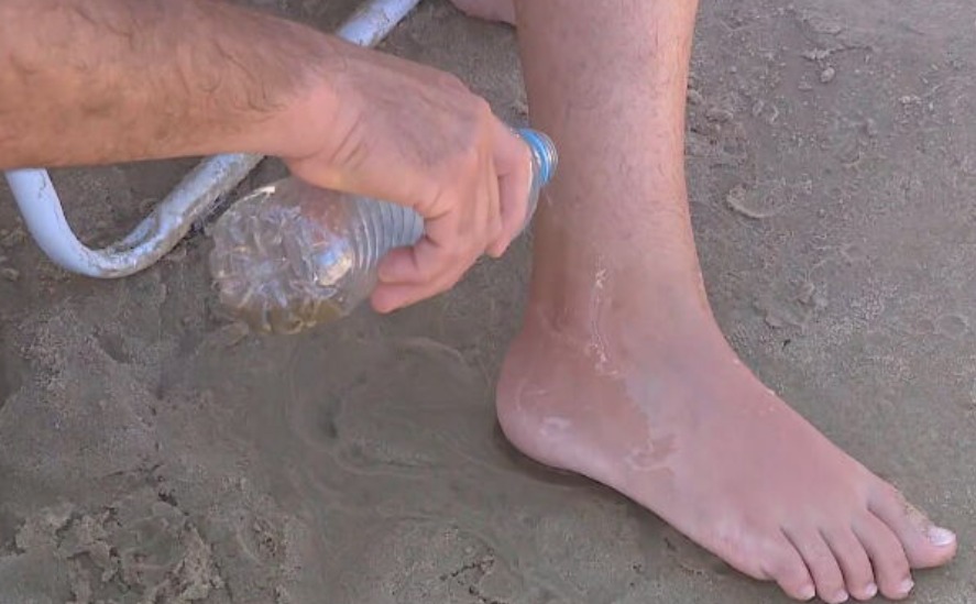 Os bombeiros afirmam que não se deve usar água doce ou água da toneira. O correto é lavar a parte do corpo que sofreu a picada com água do mar ou vinagre.