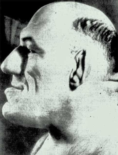 Quando estava na casa dos 20 anos, Tillet percebeu um inchaço estranho em várias partes do corpo, como pés, mãos e cabeça. Decidiu consultar um médico, que diagnosticou Acromegalia, uma condição causada por um tumor benigno na glândula pituitária.