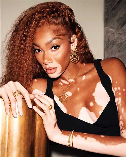 Portadora de vitiligo, Winnie revolucionou o padrão da indústria ao desfilar com sua condição de pele e provar que a beleza é múltipla. Mais que números, sua presença reafirma o poder da representatividade e a força de uma estética real, corajosa e única.
