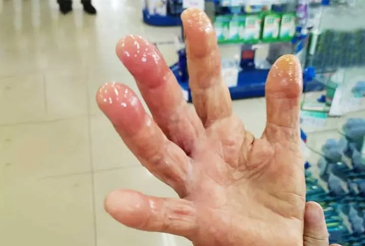 Vale destacar que casos graves de envenenamento desses animais podem evoluir para síndrome hemorrágica grave, caracterizada por alteração na coagulação, equimose (manchas), injúria renal aguda (IRA) e hemorragia generalizada, levando à morte. 