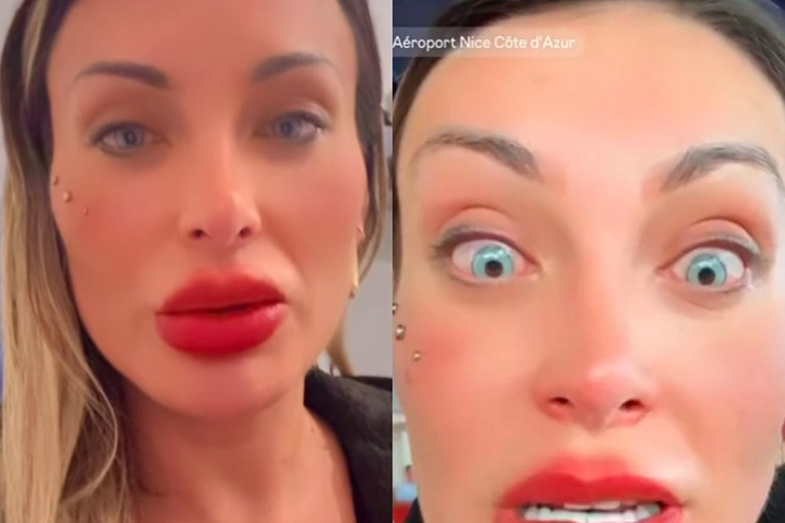 Tá doendo muito, lacrimeja muito e mal consigo enxergar. [...] Tô muito arrependida. E medo de ficar cega!, disse ela, que realizou o procedimento na França.