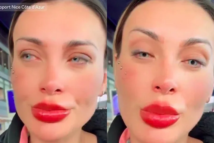 Três dias depois de passar por um procedimento cirúrgico para alterar a cor dos olhos, a modelo e influenciadora Andressa Urach foi às redes relatar efeitos negativos que vem sofrendo.