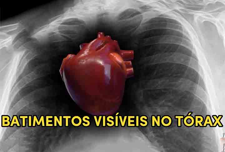 Em determinados casos, como os de fibrilação atrial e flutter atrial, a arritmia pode levar à formação de coágulos no coração, provocando derrames (AVC), de acordo com o Hospital Albert Einstein.