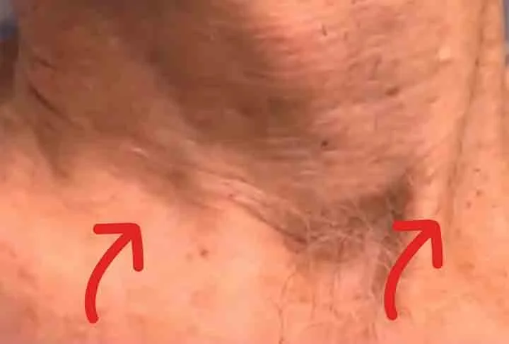 Para um diagnóstico preciso, é feita uma avaliação clínica, exame físico e eletrocardiograma. Por outro lado, em determinados casos, é preciso do teste ergométrico, o Holter, que registra o batimento cardíaco do paciente em suas atividades durante o dia.