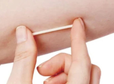 Caucaia inicou inser&ccedil;&atilde;o de implanon na rede muncipal de sa&uacute;de  