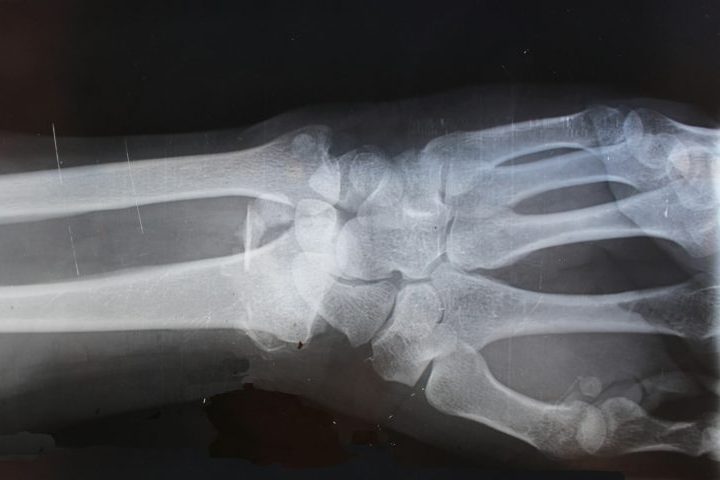 A descoberta não apenas explicou a condição do homem, mas também abriu portas para um possível tratamento da osteoporose.