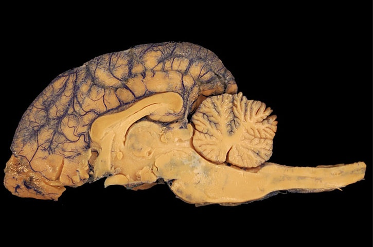  A demência, na verdade, é um nome genérico dado a um grupo de doenças cerebrais, que, se não forem tratadas, levam à morte. As doenças costumam afetar algumas funções cerebrais, mas não a consciência da pessoa.