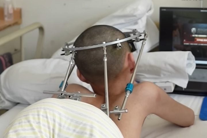 Ele conviveu dessa forma desde a infância. Sua mobilidade e atividades diárias eram extremamente limitadas.