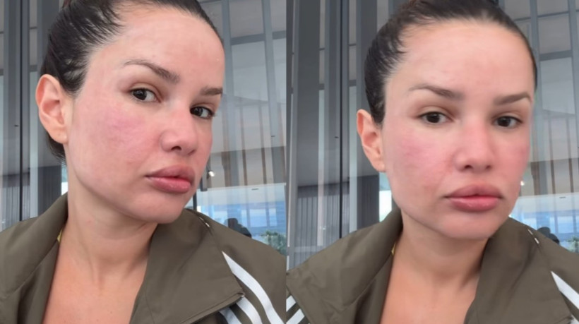 Juliette fica com rosto inchado após procedimento estético