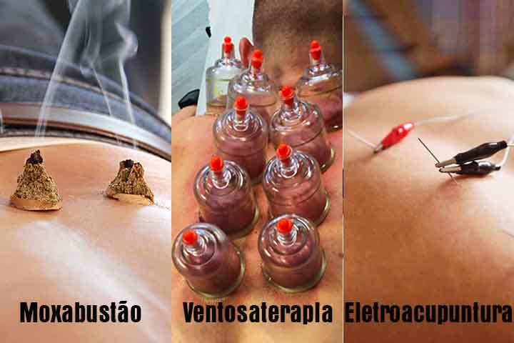 Ela é baseada na teoria dos meridianos, canais por onde flui a energia vital (Qi), e busca restaurar o bem-estar físico e emocional. A prática envolve também outros métodos, como a moxabustão, ventosaterapia e eletroacupuntura.