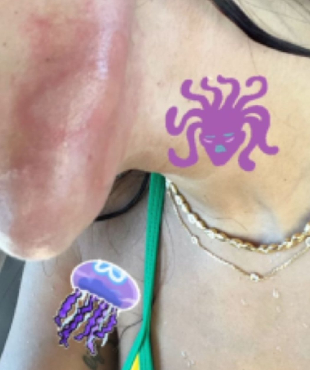 A cantora Anitta divulgou recentemente que foi queimada por uma água-viva durante mergulho numa gruta em Ibiza, ilha da Espanha, no Mar Mediterrâneo.  Lutei com ela e nunca senti tanta dor. Como se fosse eletrocutada, disse.