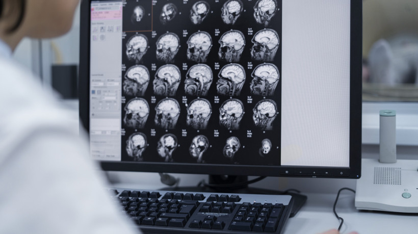 Ao observar dados como redução do volume da substância cinzenta e branca e atrofia hipocampal, o modelo criado pelos pesquisadores consegue estimar o envelhecimento cerebral com mudanças na velocidade de processamento, lentificação motora, queda de memória e coordenação prejudicada 