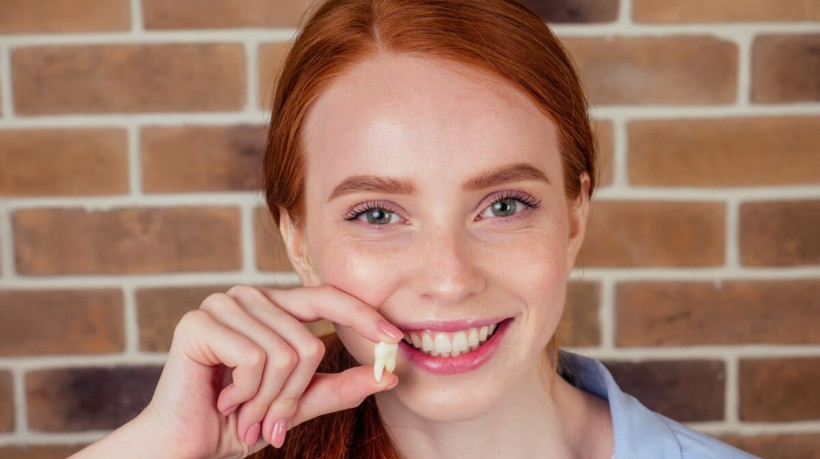 6 mitos e verdades sobre o dente do siso