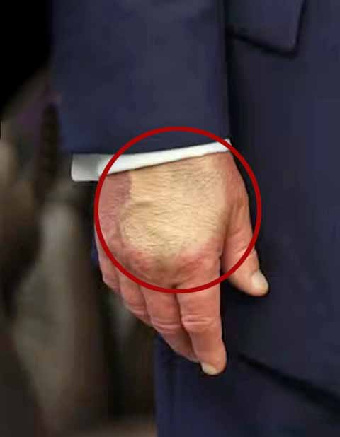 Segundo a porta-voz da Casa Branca, Karoline Leavitt, exames descartaram outras doenças sistêmicas em Donald Trump, como trombose venosa profunda, insuficiência cardíaca ou renal. 
