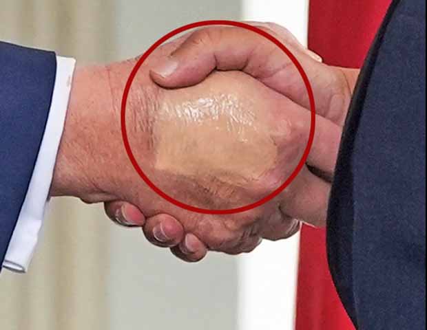 Os hematomas observados nas mãos de Trump teriam origem em pequenas irritações provocadas por apertos frequentes de mão e pelo uso de aspirina. 

