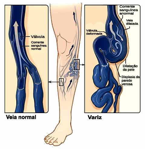A insuficiência venosa crônica é uma condição em que as veias - principalmente as das pernas - perdem a capacidade de transportar o sangue de volta ao coração de forma eficiente. 
