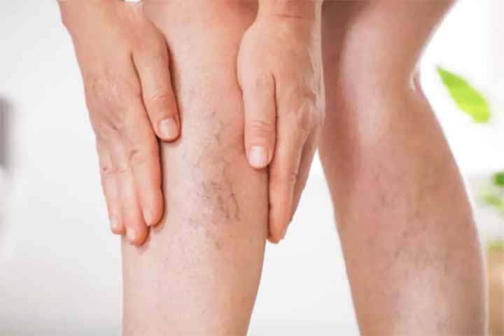 Isso acontece porque as válvulas venosas, pequenas estruturas que funcionam como “portas unidirecionais” para o fluxo sanguíneo, ficam danificadas ou enfraquecidas.
