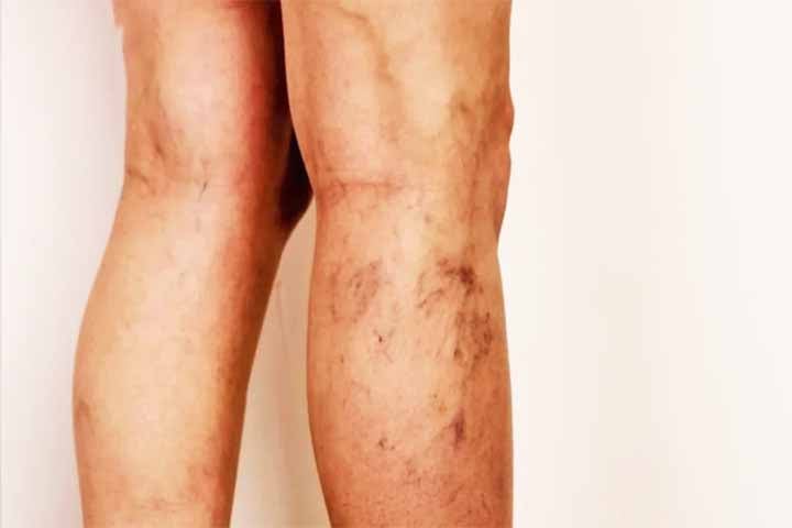 Isso aumenta a pressão dentro das veias e provoca uma série de sintomas e sinais visíveis na pele.
