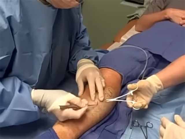 A cirurgia para insuficiência venosa crônica é considerada apenas um último recurso, quando o tratamento clínico não dá bons resultados.