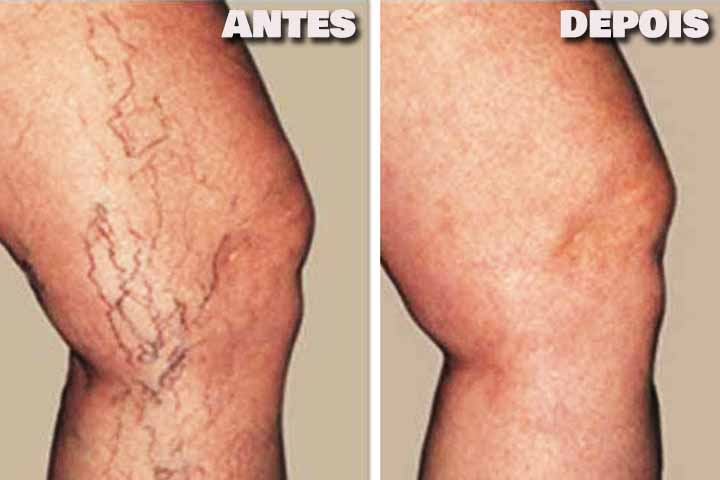 Essas práticas auxiliam na melhora da circulação sanguínea e aliviam os sintomas. 
