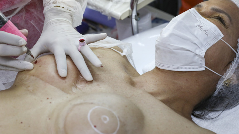 A micropigmentação paramédica recria a aréola do mamilo e devolve à mulher parte de sua autoconfiança
