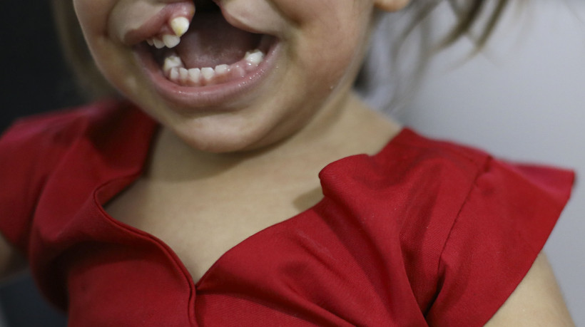FORTALEZA, CEAR&Aacute;, BRASIL,09.10.2025: Crian&ccedil;a com labio Leporino. Projeto N&uacute;cleo de Atendimento Integrado ao Fissurado (Naif) do Albert Sabin. (foto: Fabio Lima/OPOVO).