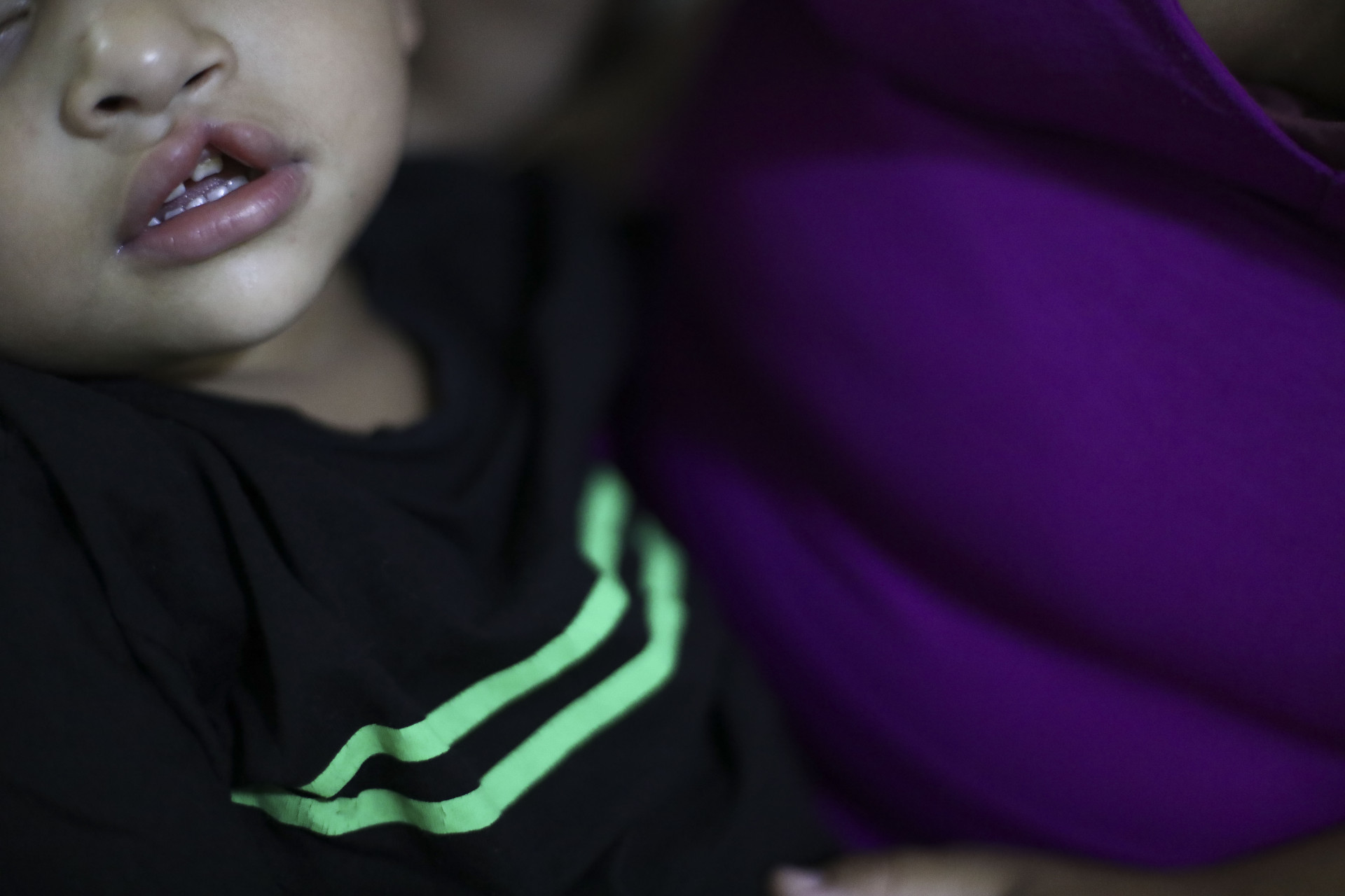 FORTALEZA, CEARÁ, BRASIL,09.10.2025: Criança com labio Leporino. Projeto Núcleo de Atendimento Integrado ao Fissurado (Naif) do Albert Sabin. (foto: Fabio Lima/OPOVO).