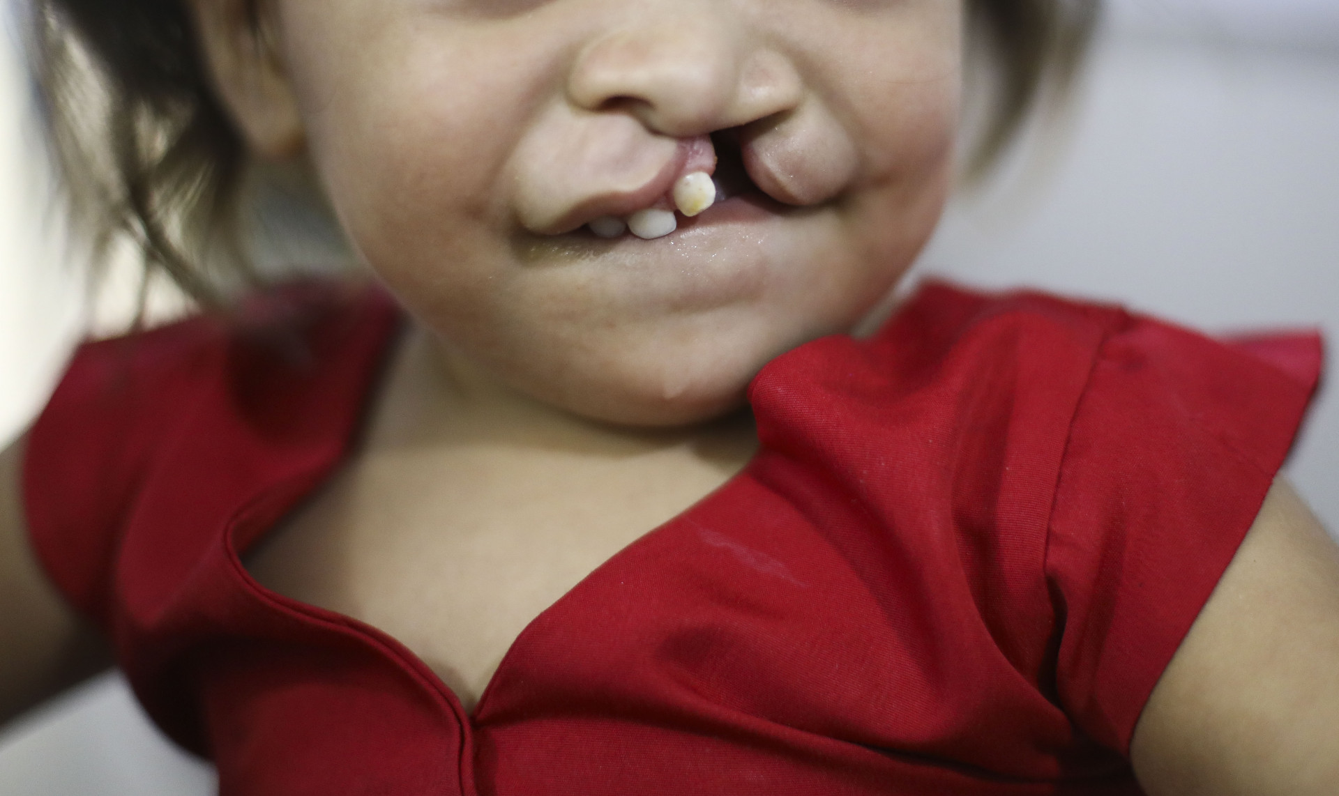 FORTALEZA, CEARÁ, BRASIL,09.10.2025: Criança com labio Leporino. Projeto Núcleo de Atendimento Integrado ao Fissurado (Naif) do Albert Sabin. (foto: Fabio Lima/OPOVO).