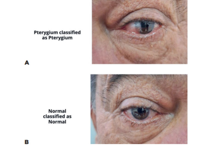 Figura apresenta caso de verdadeiro-positivo (foto acima) e verdadeiro-negativo (foto debaixo) nos olhos do mesmo paciente 