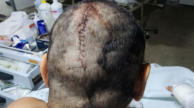 A mulher teve 283 pontos na cabeça e foi vítima de mais de 20 golpes de faca espalhados pelo corpo. 