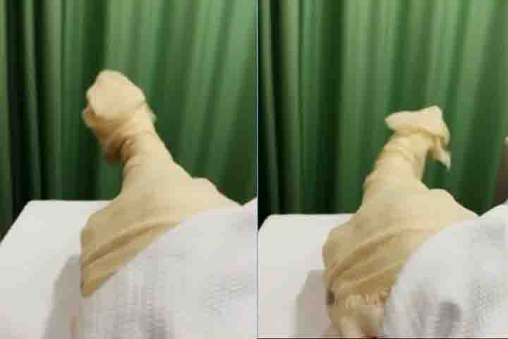 O filtro de veia cava é indicado quando anticoagulantes não podem ser utilizados. Ele impede que coágulos cheguem aos pulmões.